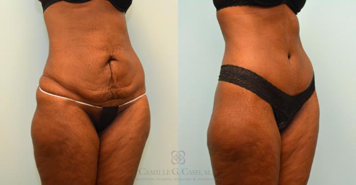 Before & After Tummy Tuck Case 395 View #3 View in Houston, TX
