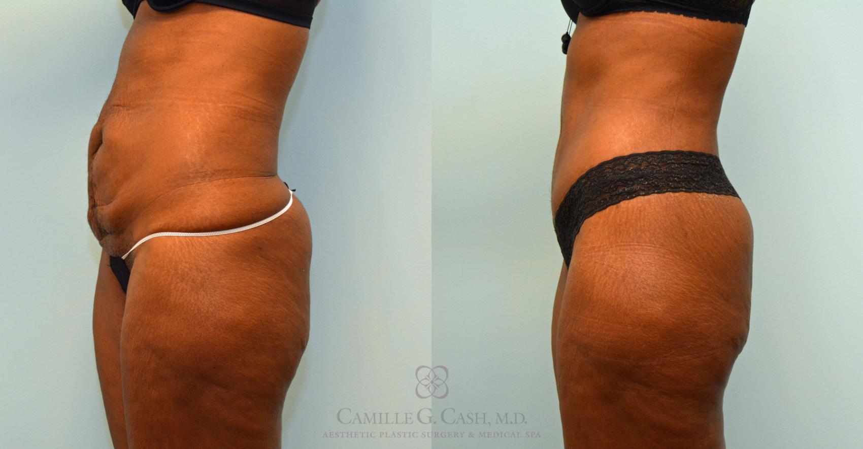 Before & After Tummy Tuck Case 395 View #4 View in Houston, TX