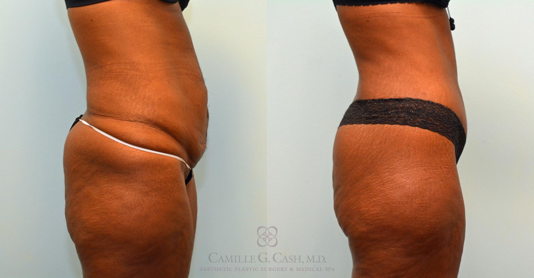 Before & After Tummy Tuck Case 395 View #5 View in Houston, TX