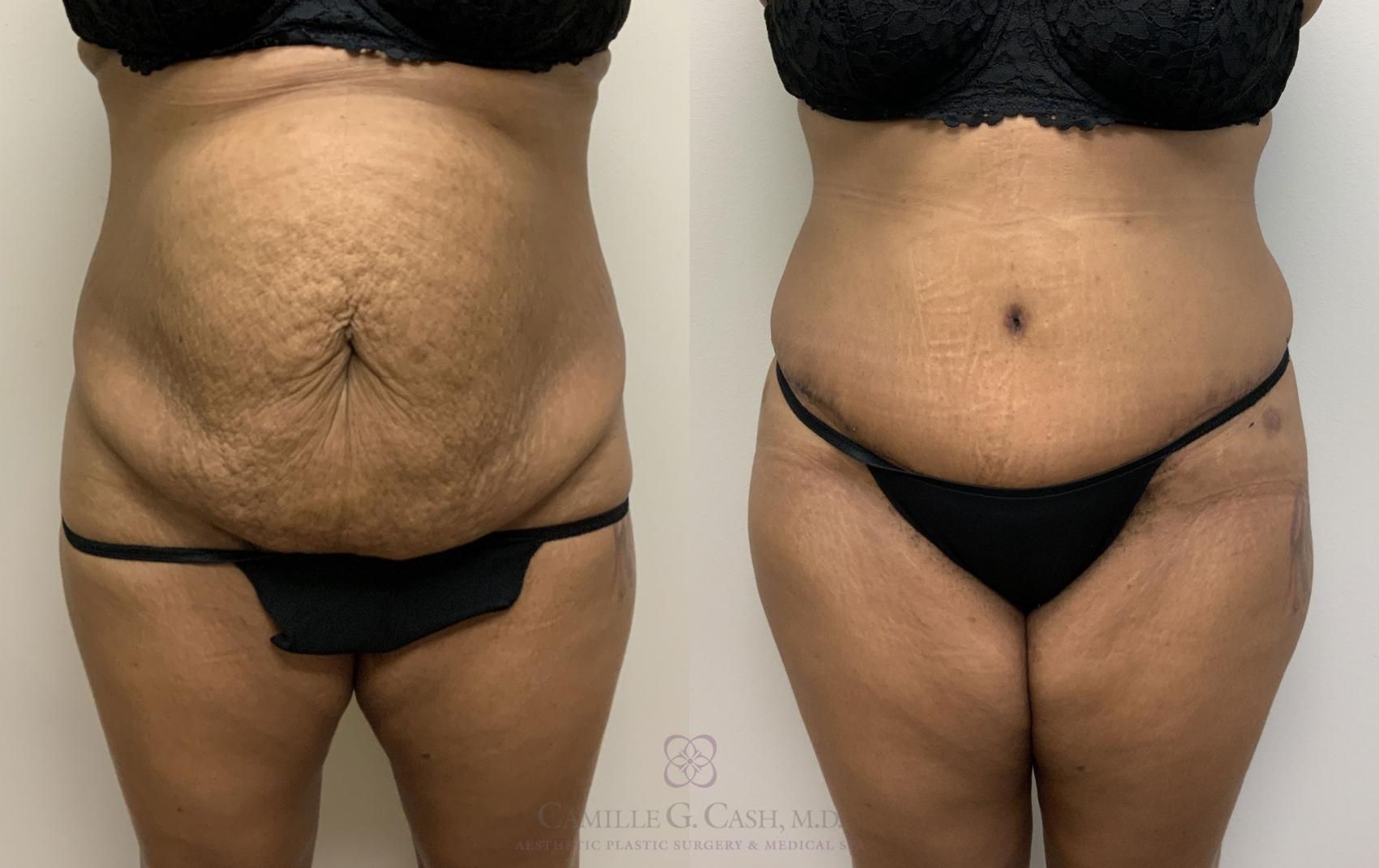 Before & After Tummy Tuck Case 400 View #1 View in Houston, TX