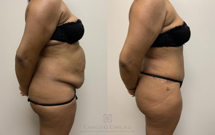 Before & After Tummy Tuck Case 400 View #2 View in Houston, TX