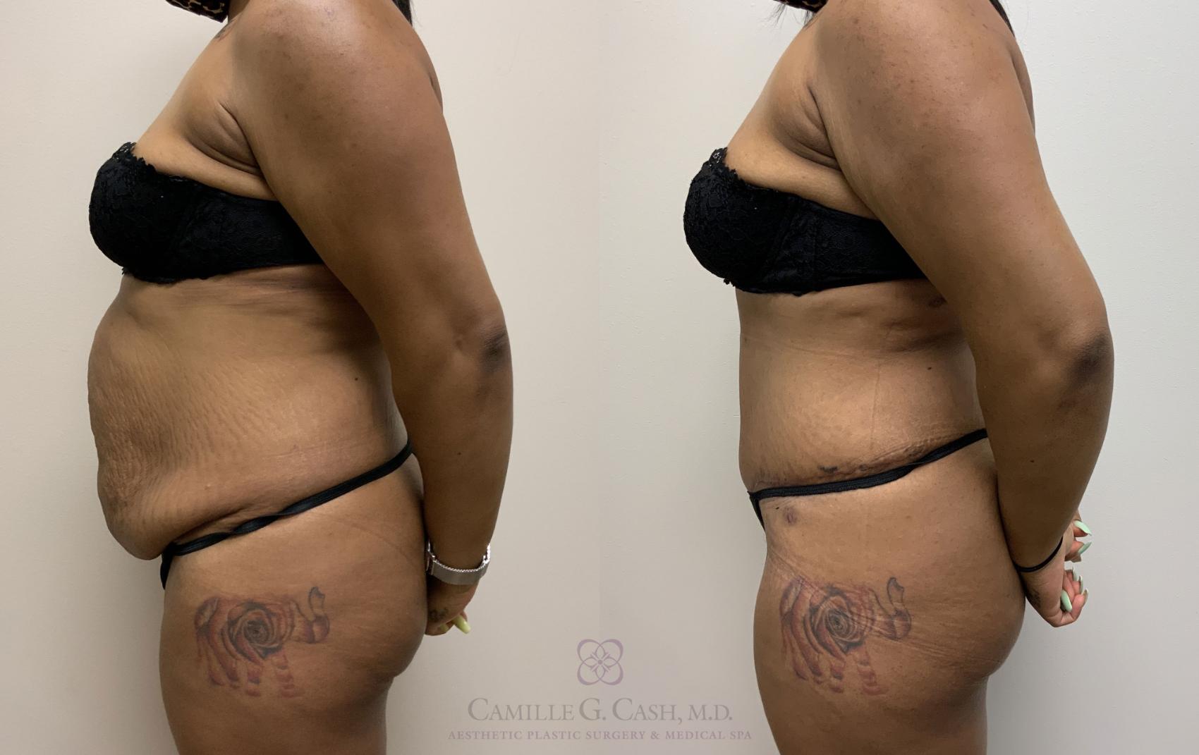Before & After Tummy Tuck Case 400 View #3 View in Houston, TX
