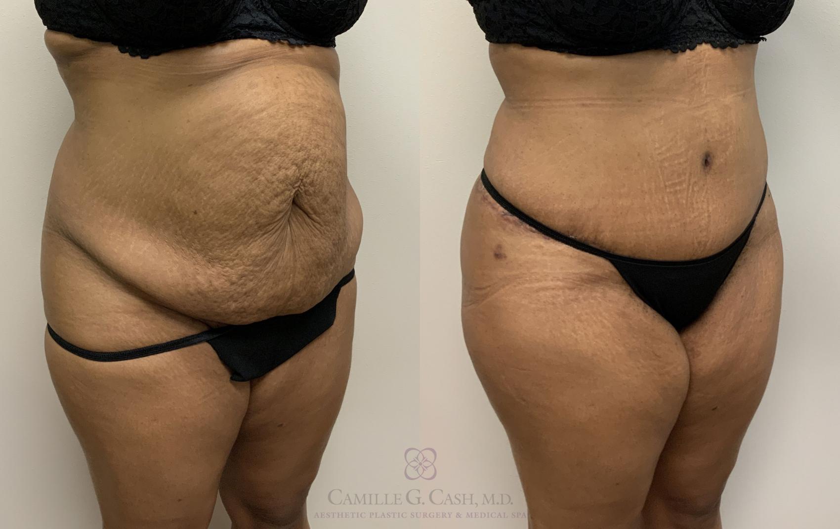 Before & After Tummy Tuck Case 400 View #4 View in Houston, TX