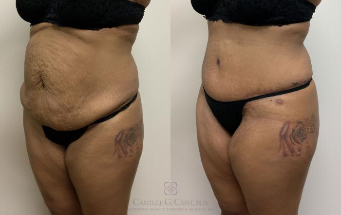 Before & After Tummy Tuck Case 400 View #5 View in Houston, TX