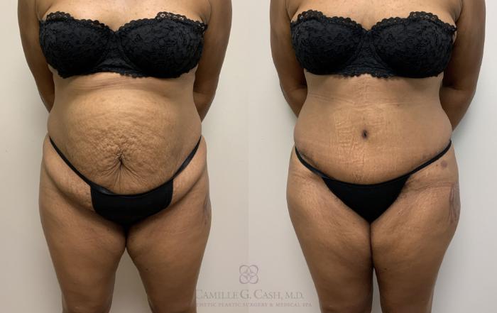 Before & After Tummy Tuck Case 400 View #6 View in Houston, TX