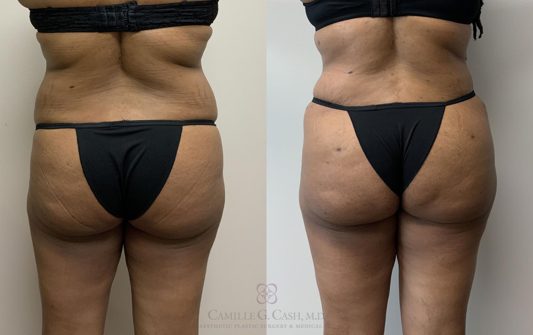 Before & After Tummy Tuck Case 400 View #7 View in Houston, TX