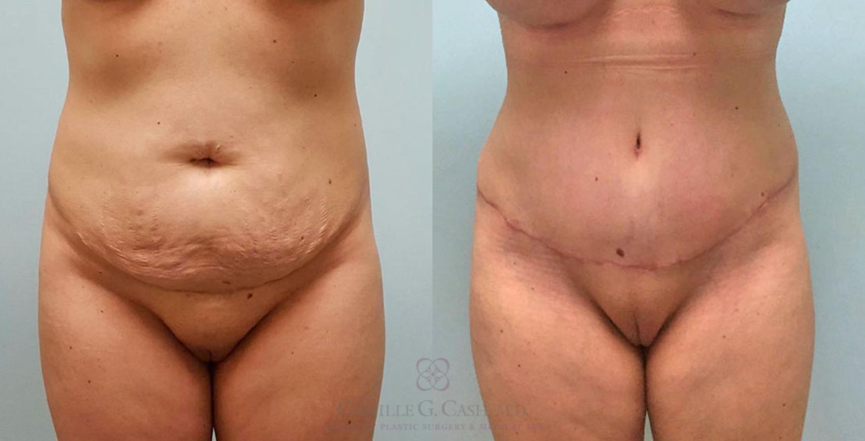 Before & After Tummy Tuck Case 404 View #1 View in Houston, TX