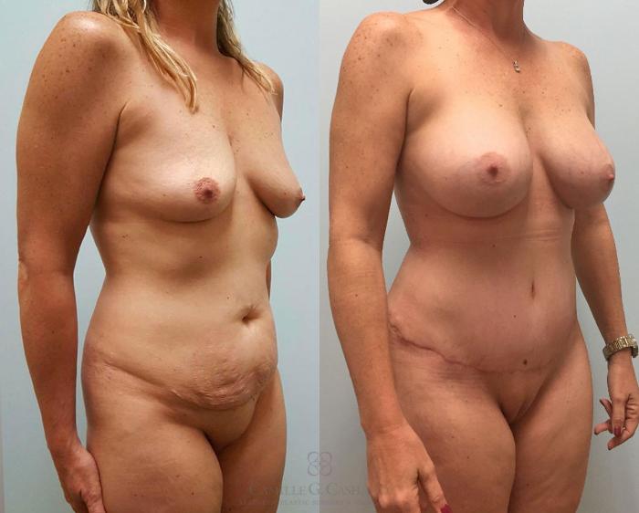 Before & After Tummy Tuck Case 404 View #2 View in Houston, TX