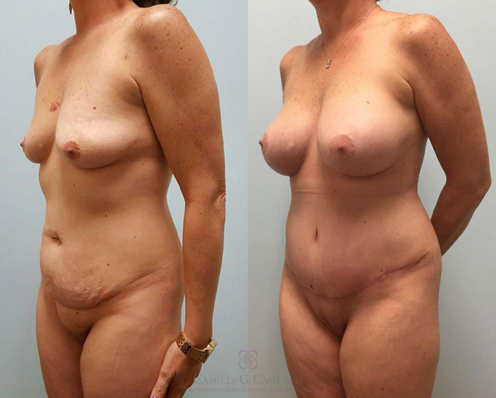 Before & After Tummy Tuck Case 404 View #3 View in Houston, TX