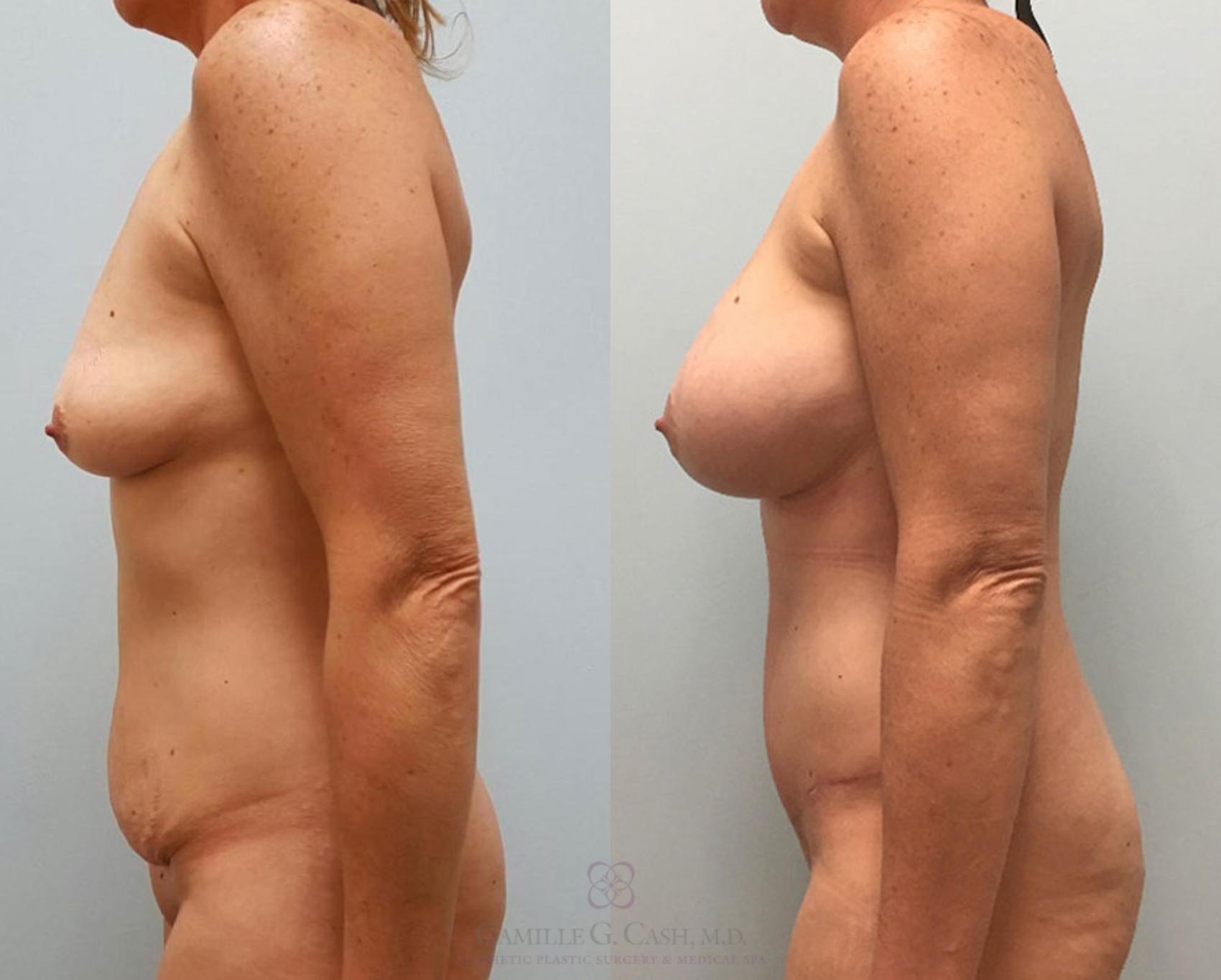 Before & After Tummy Tuck Case 404 View #4 View in Houston, TX