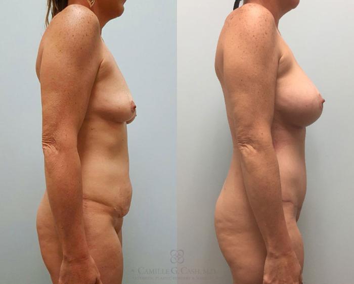 Before & After Tummy Tuck Case 404 View #5 View in Houston, TX