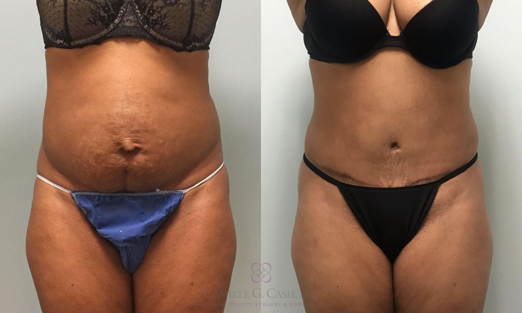 Before & After Tummy Tuck Case 425 View #1 View in Houston, TX