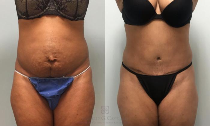 Before & After Tummy Tuck With Hernia Repair Case 425 View #1 View in Houston, TX