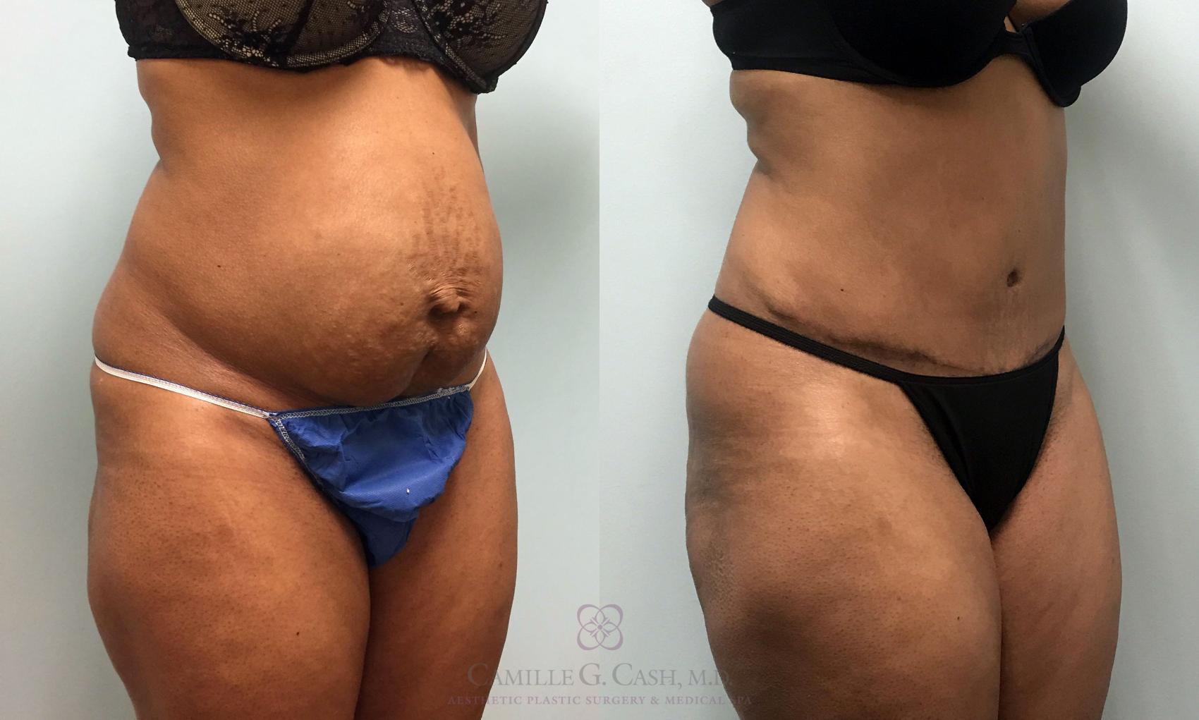 Before & After Tummy Tuck Case 425 View #2 View in Houston, TX