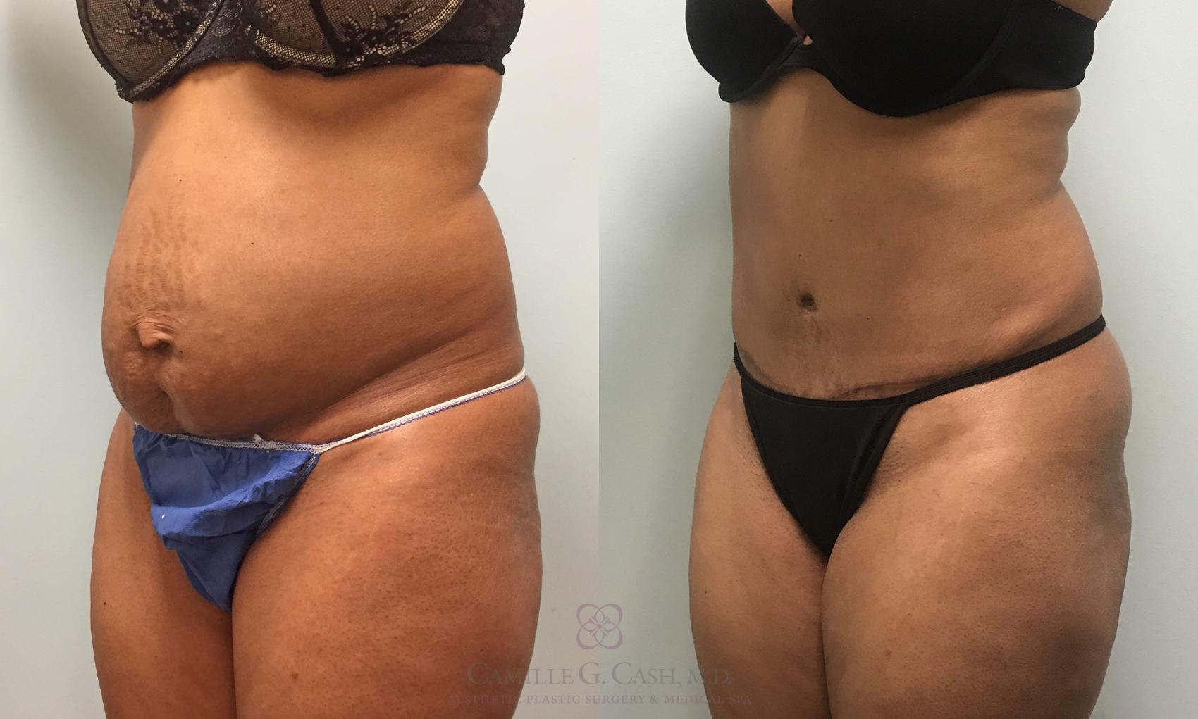 Before & After Tummy Tuck Case 425 View #3 View in Houston, TX