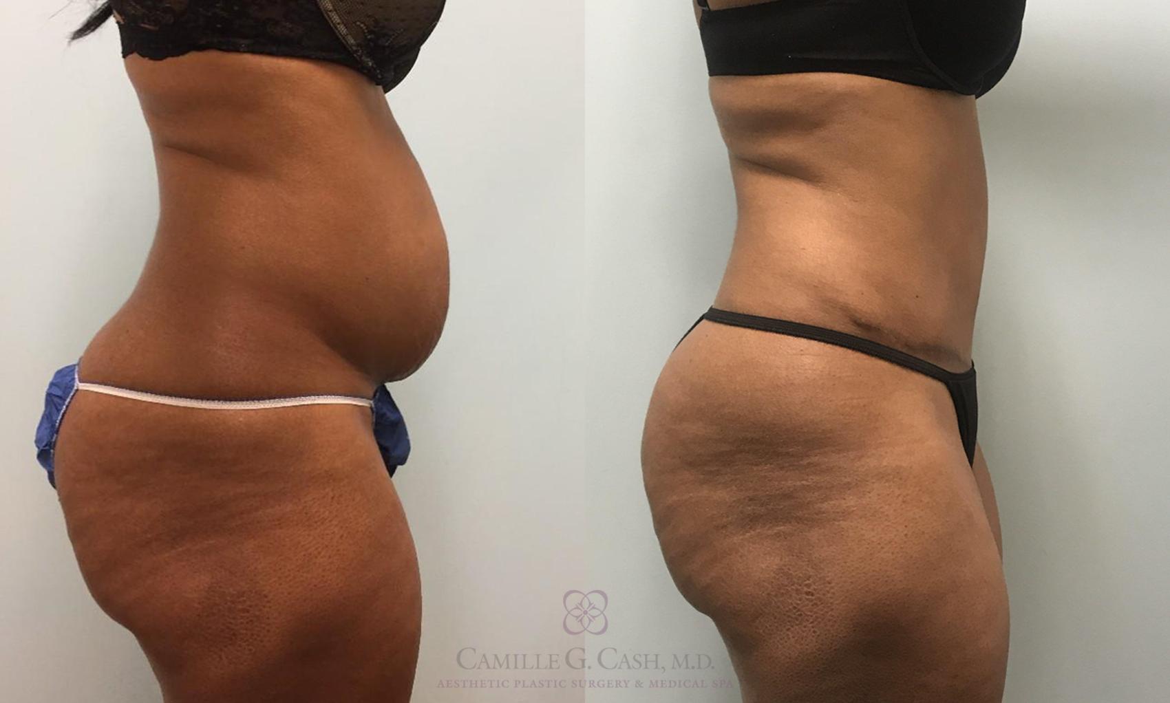 Before & After Tummy Tuck Case 425 View #4 View in Houston, TX