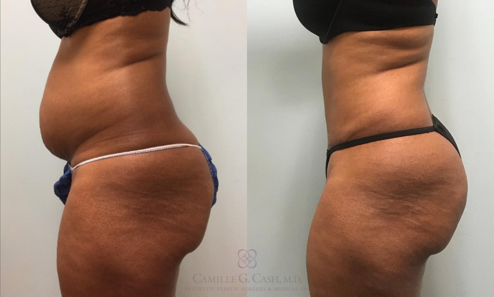 Before & After Tummy Tuck Case 425 View #5 View in Houston, TX