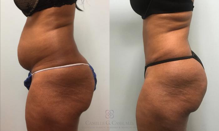 Before & After Tummy Tuck With Hernia Repair Case 425 View #5 View in Houston, TX