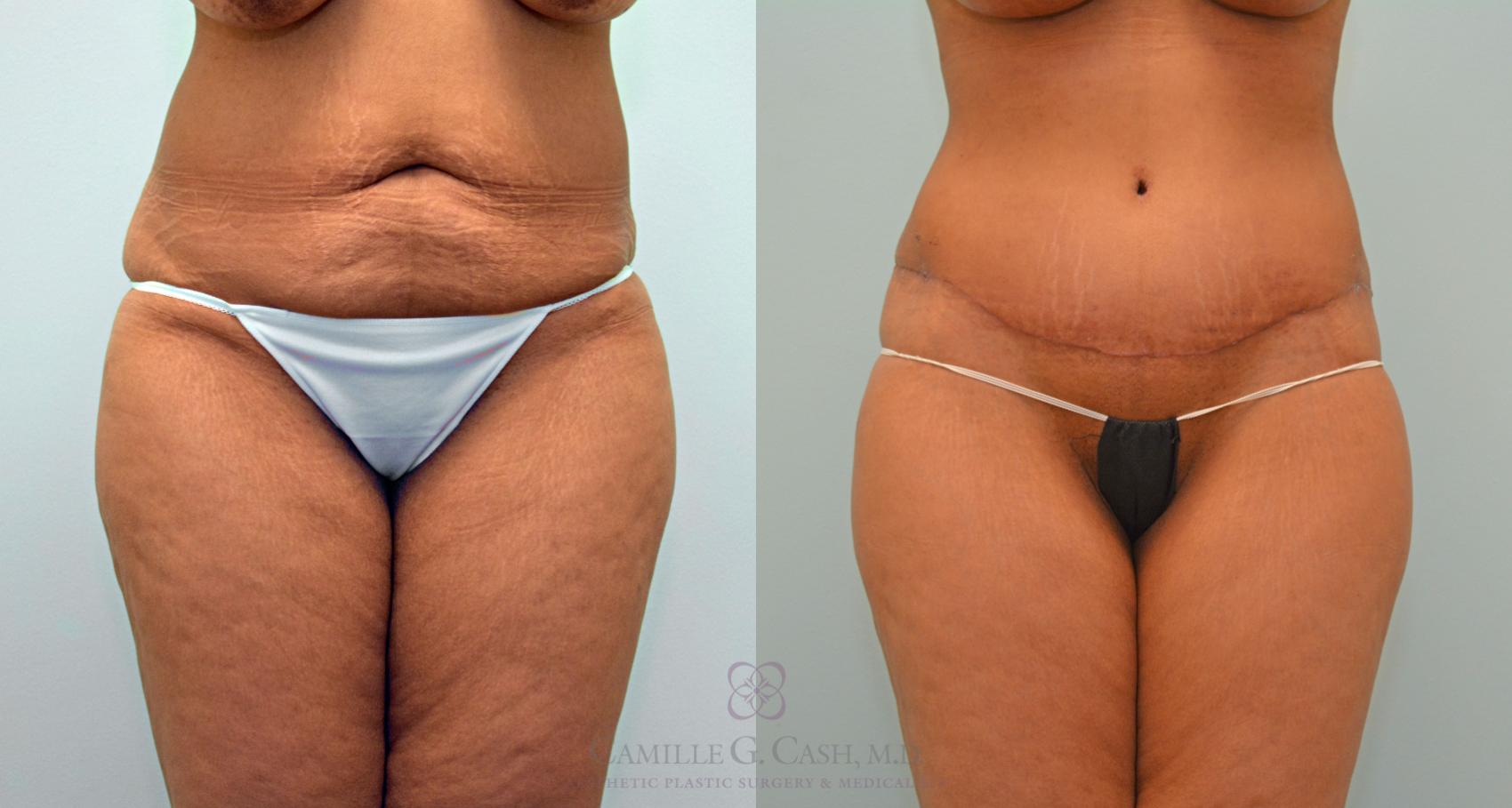 Before & After Tummy Tuck Case 427 View #1 View in Houston, TX