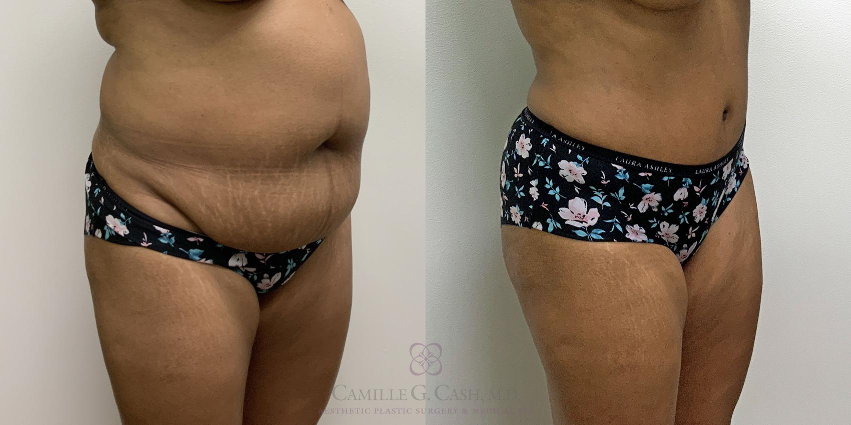 Before & After Tummy Tuck Case 435 View #1 View in Houston, TX