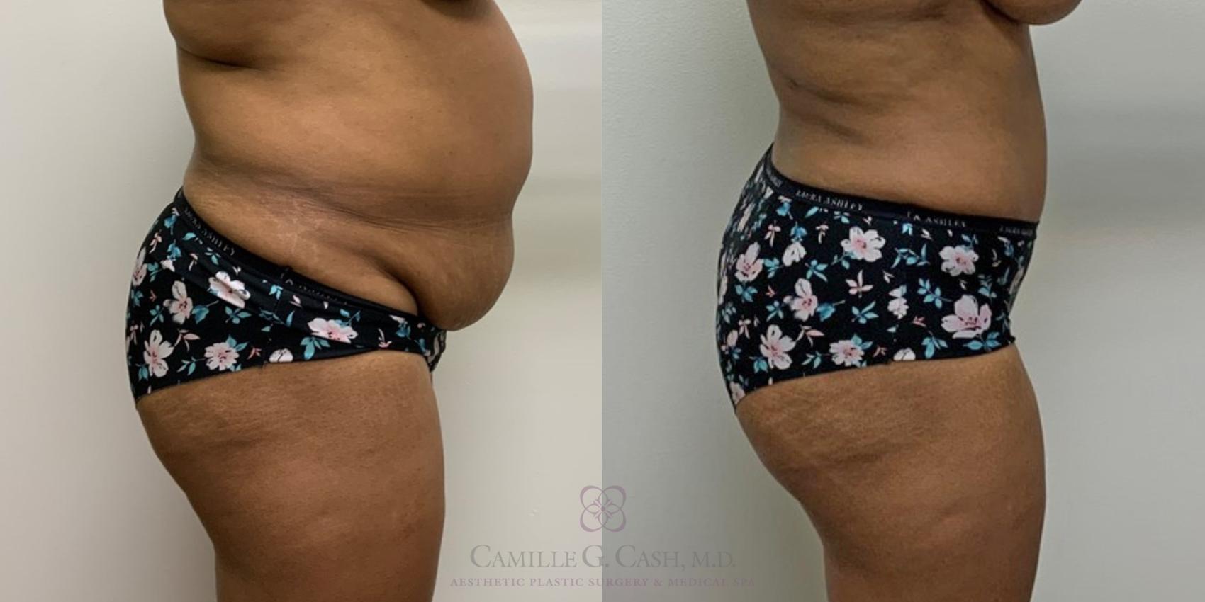 Before & After Tummy Tuck Case 435 View #2 View in Houston, TX