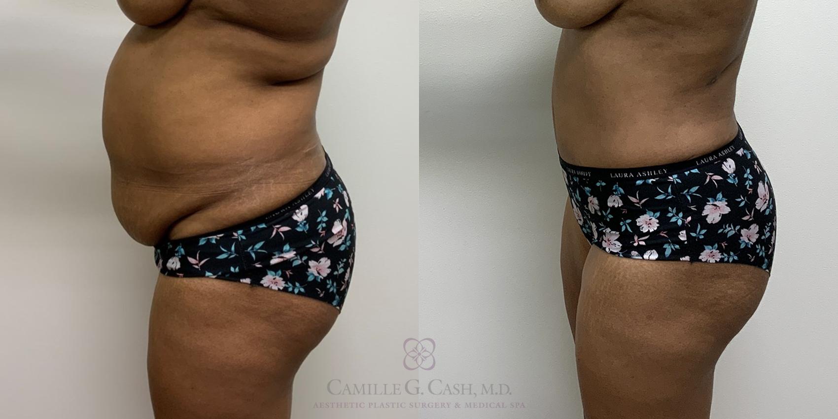Before & After Tummy Tuck Case 435 View #3 View in Houston, TX