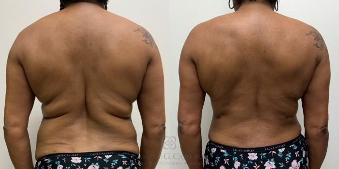 Before & After Tummy Tuck Case 435 View #4 View in Houston, TX