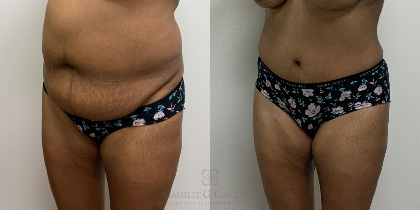 Before & After Tummy Tuck Case 435 View #5 View in Houston, TX