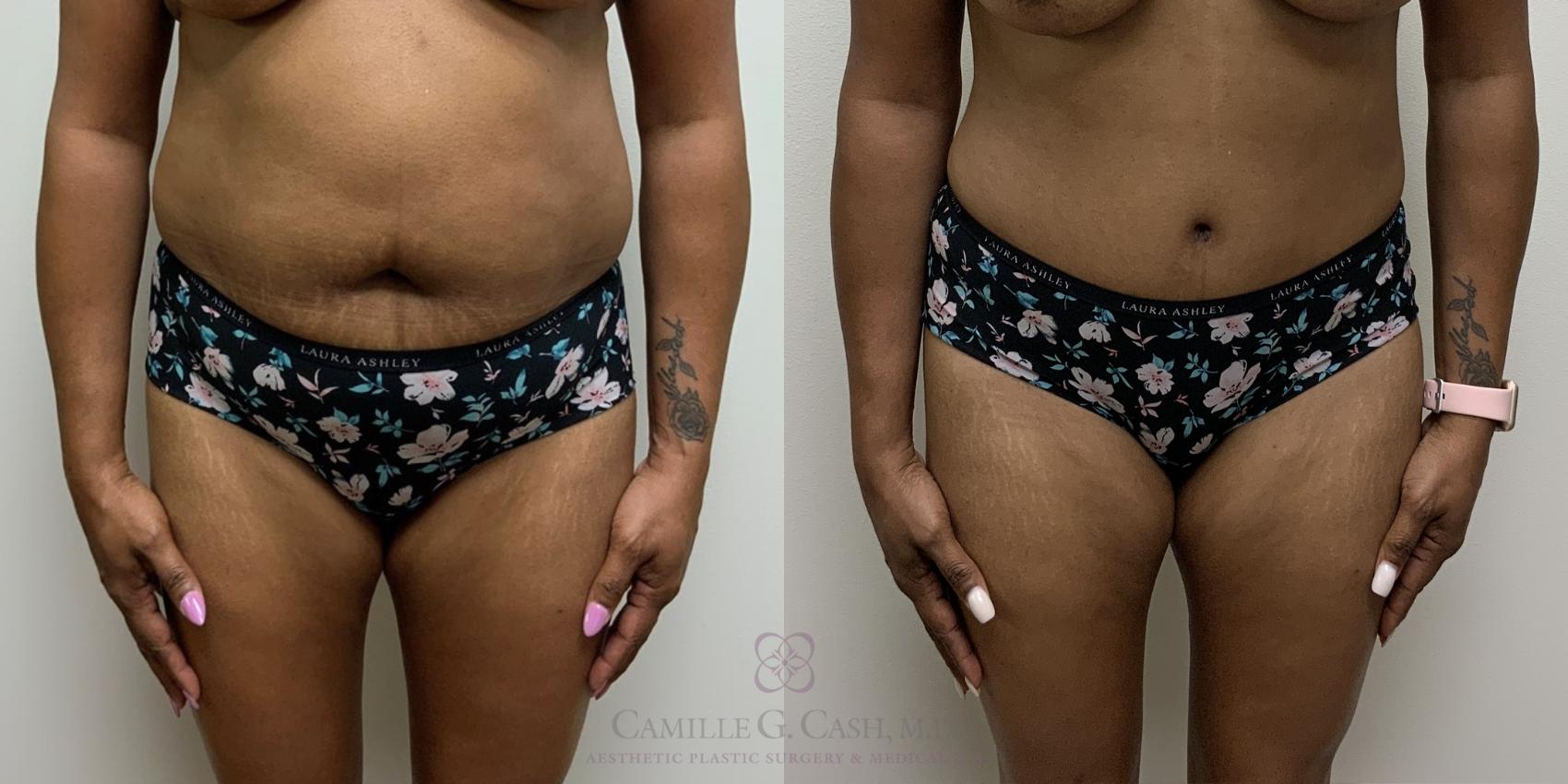 Before & After Tummy Tuck Case 435 View #6 View in Houston, TX