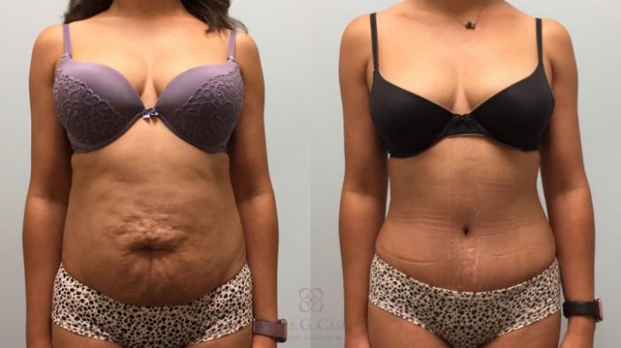 Before & After Tummy Tuck Case 444 View #1 View in Houston, TX