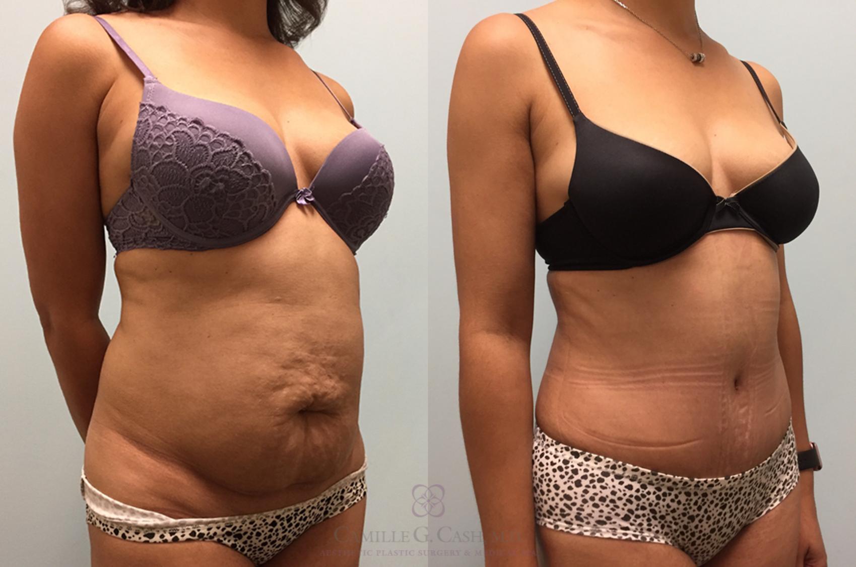 Before & After Tummy Tuck Case 444 View #2 View in Houston, TX