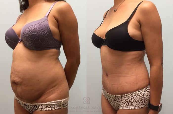 Before & After Tummy Tuck Case 444 View #3 View in Houston, TX