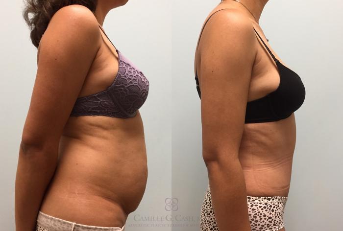 Before & After Tummy Tuck Case 444 View #4 View in Houston, TX