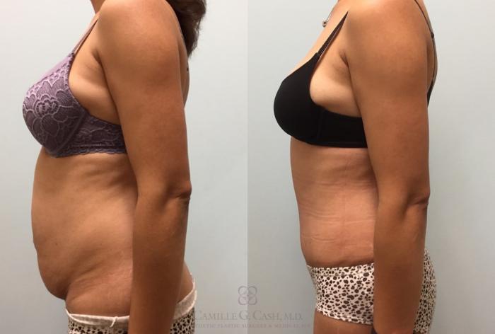 Before & After Tummy Tuck Case 444 View #5 View in Houston, TX