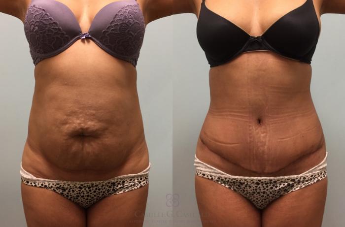 Before & After Tummy Tuck Case 444 View #6 View in Houston, TX