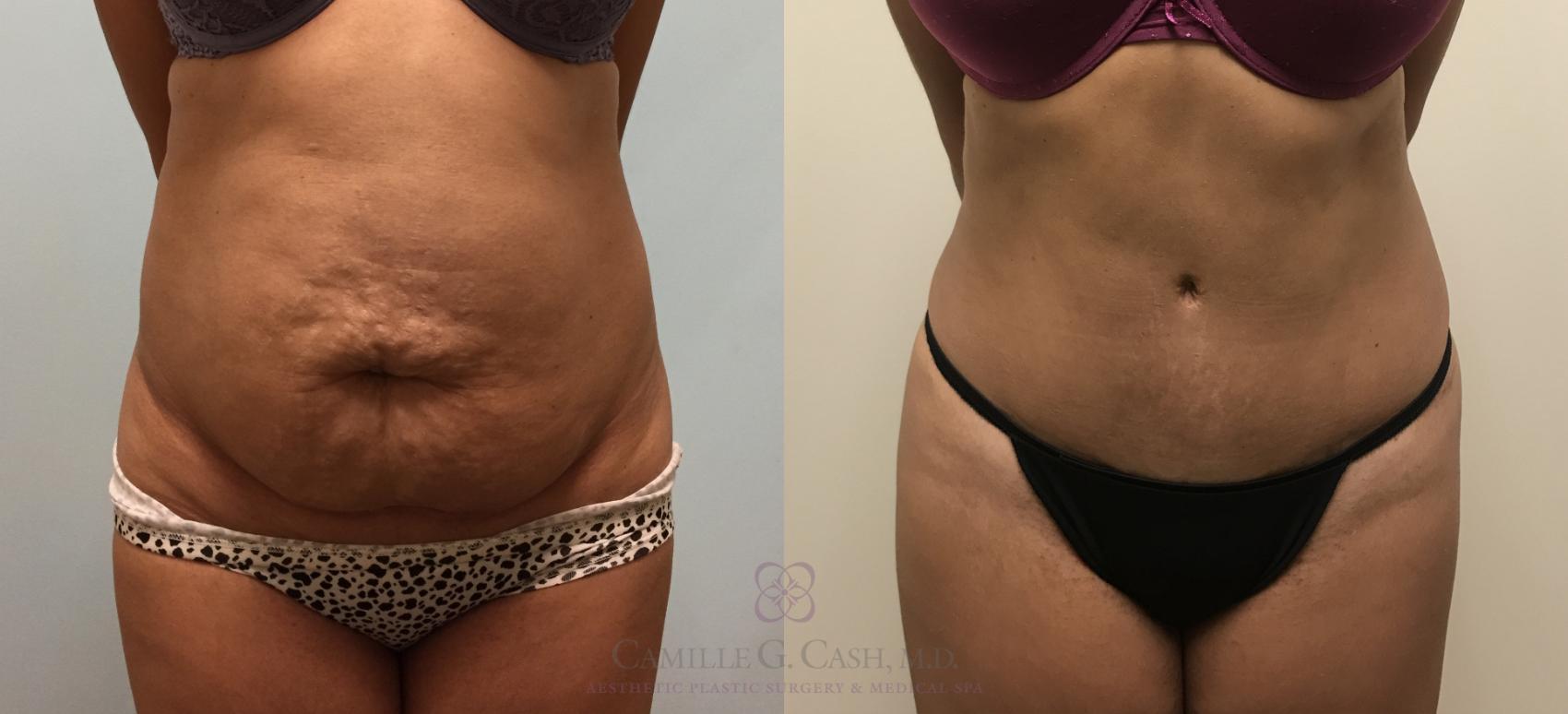 Before & After Tummy Tuck Case 444 View #7 View in Houston, TX