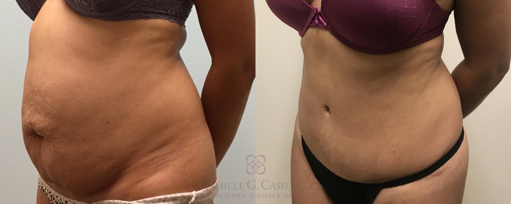 Before & After Tummy Tuck Case 444 View #8 View in Houston, TX
