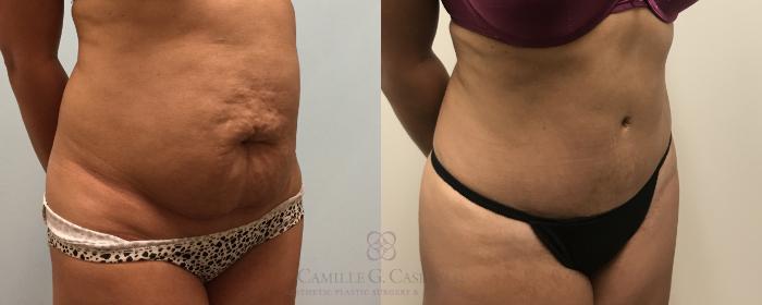 Before & After Tummy Tuck Case 444 View #9 View in Houston, TX