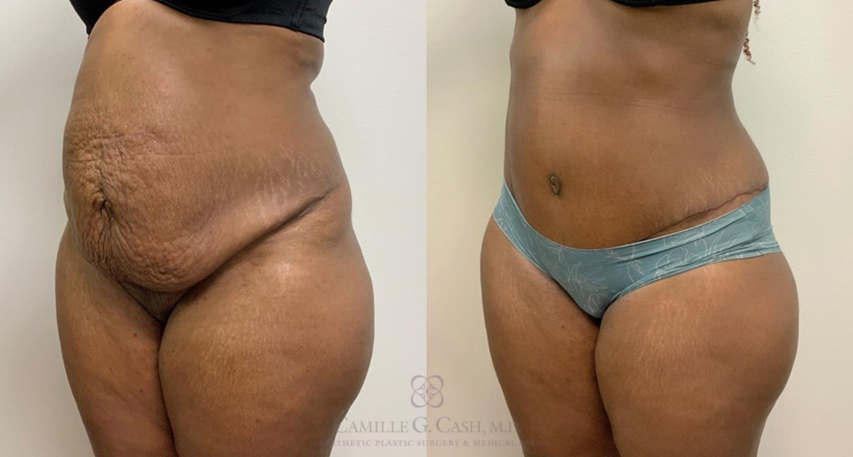 Before & After Tummy Tuck Case 450 Left Oblique View in Houston, TX