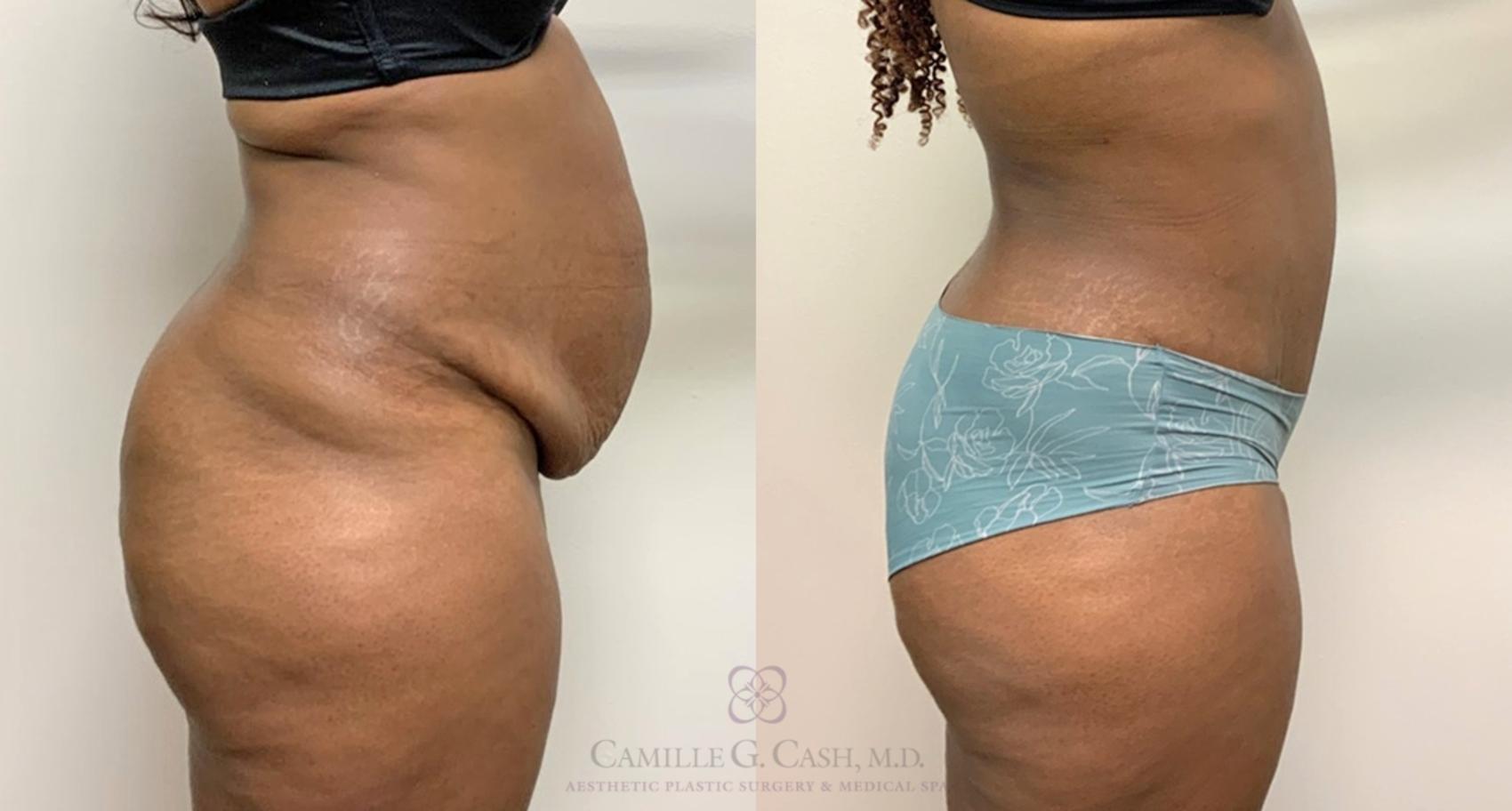 Before & After Tummy Tuck Case 450 Left Side View in Houston, TX