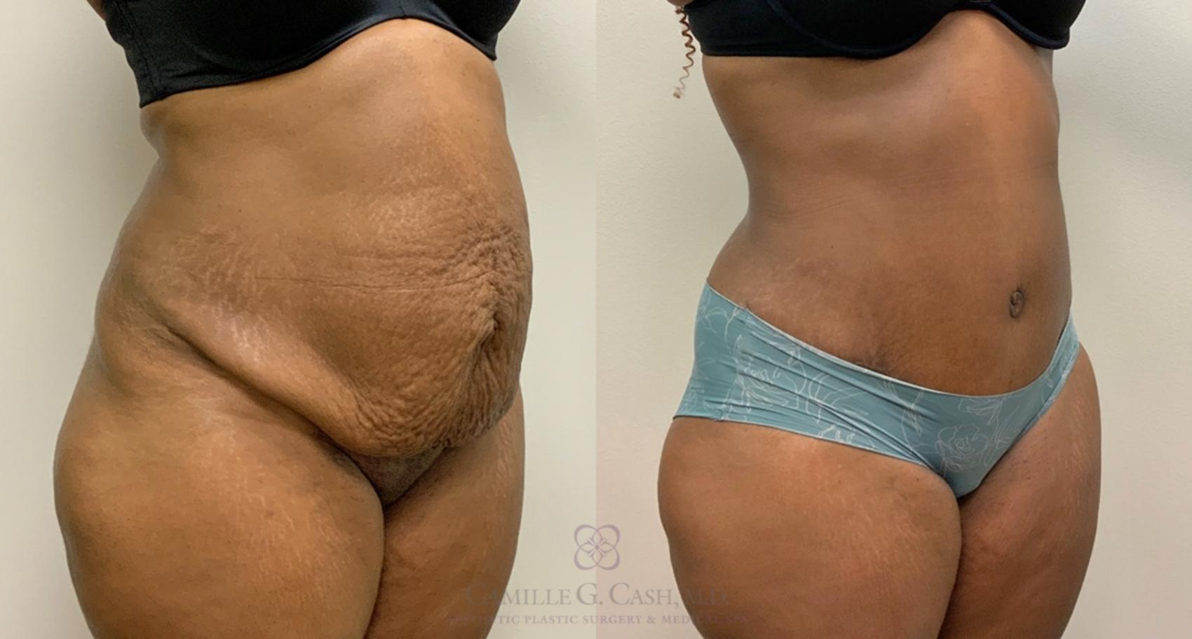 Before and after tummy tuck with liposuction