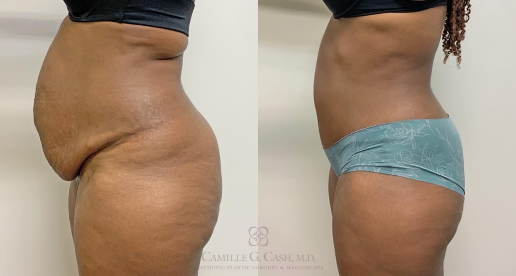Before & After Tummy Tuck Case 450 Right Side View in Houston, TX