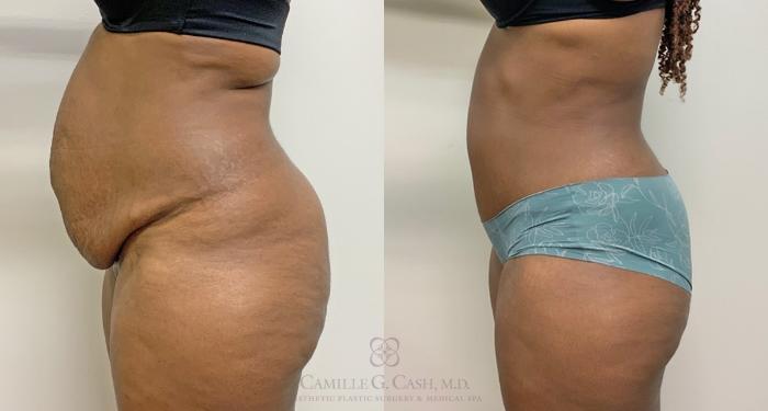 Before & After Tummy Tuck Case 450 Right Side View in Houston, TX
