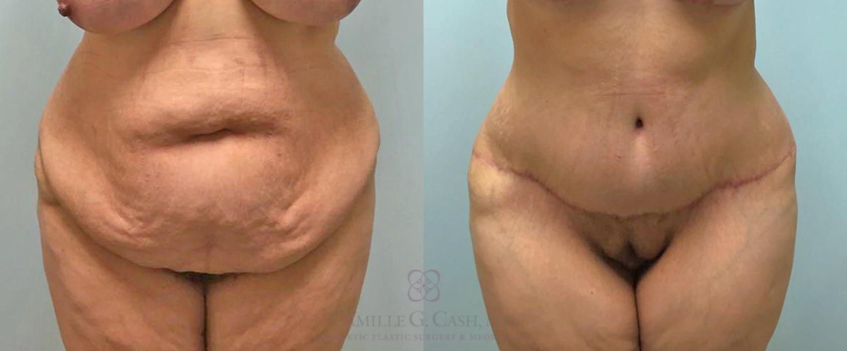 Before & After Tummy Tuck Case 464 Front View in Houston, TX
