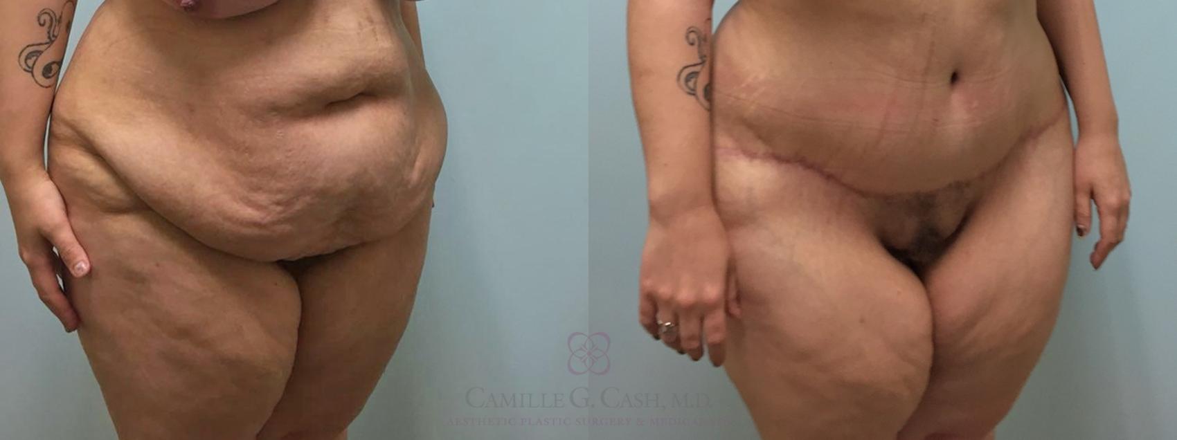Before & After Tummy Tuck Case 464 Left Oblique View in Houston, TX