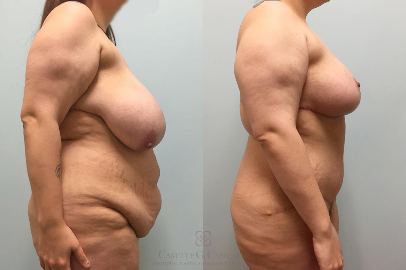 Before & After Tummy Tuck Case 464 Left Side View in Houston, TX