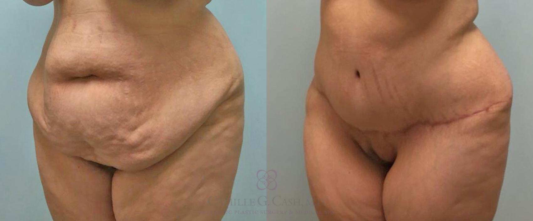 Before & After Tummy Tuck Case 464 Right Oblique View in Houston, TX