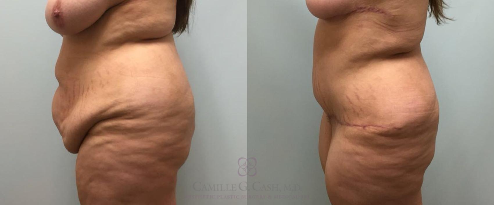 Before & After Tummy Tuck Case 464 Right Side View in Houston, TX