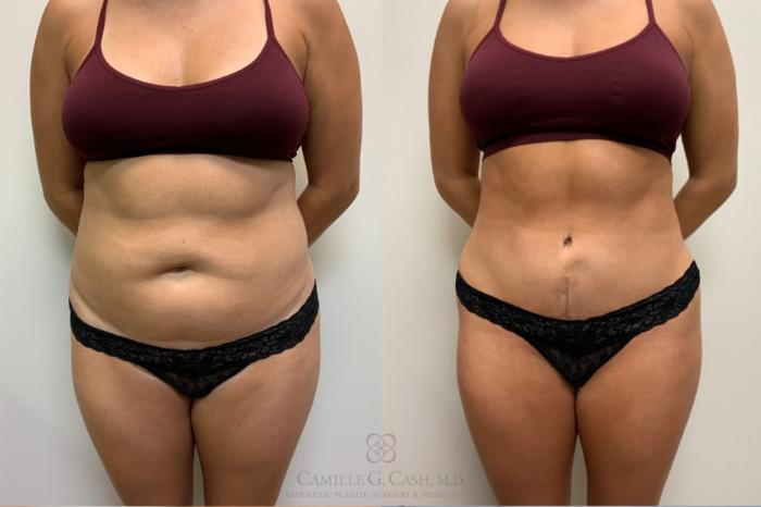 Before & After Tummy Tuck Case 487 Front View in Houston, TX