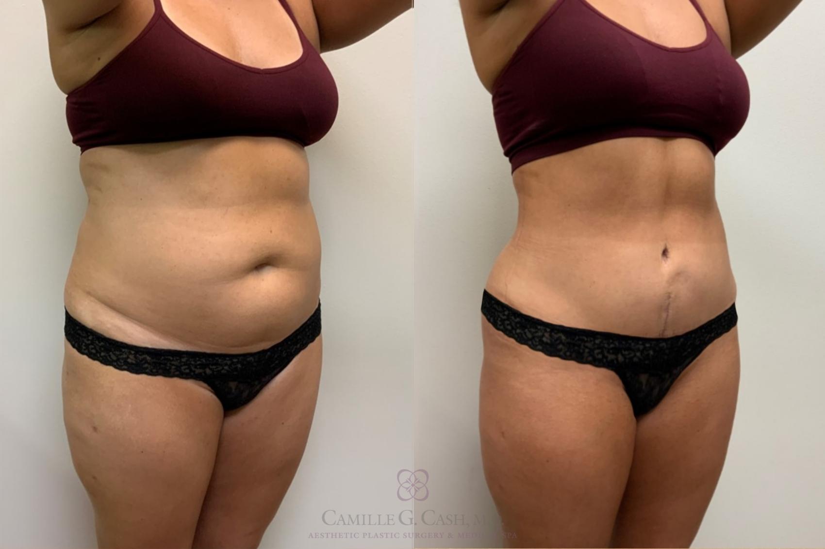 Before & After Tummy Tuck Case 487 Left Oblique View in Houston, TX